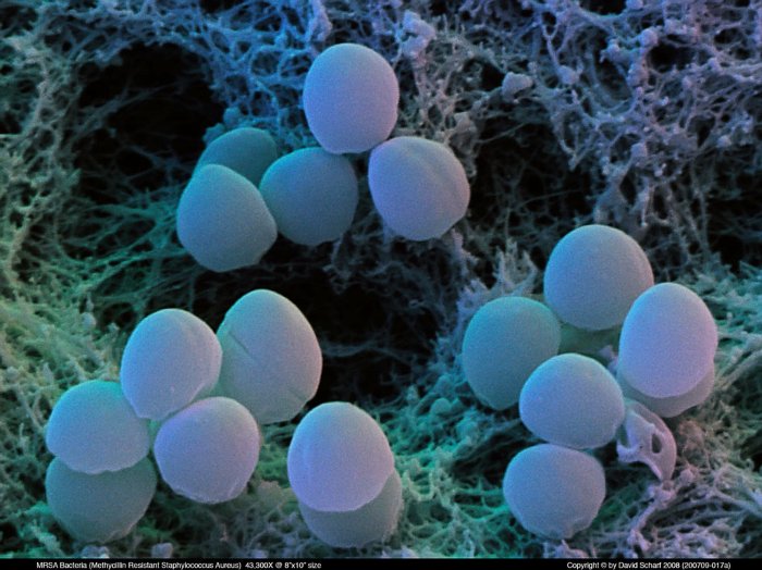 200709-017a-Staph-Aureus-MRSA1