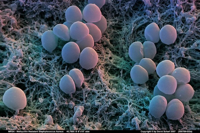 200709-032a-Staph-Aureus-MRSA1