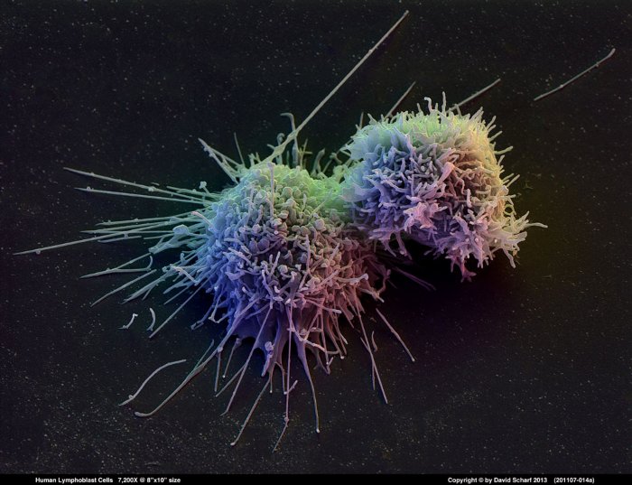 201107-014a-Lymphoblast-Cells1